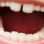زمان رویش اولین دندان آسیای دائمی‌ یا دندان ششم