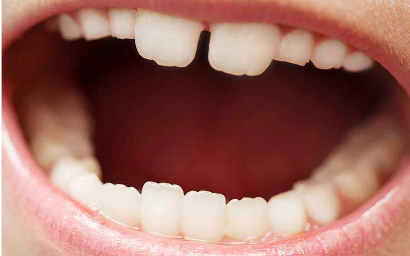 زمان رویش اولین دندان آسیای دائمی‌ یا دندان ششم