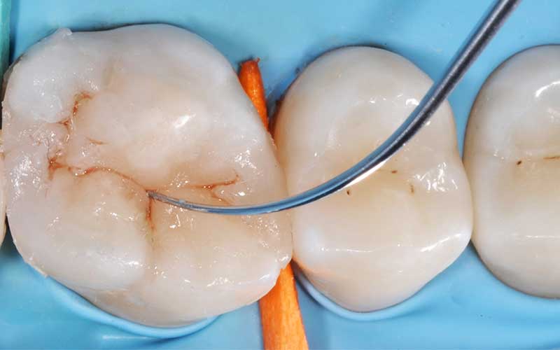 کاربرد شیارپوش در دندانپزشکی کودکان(فیشورسیلانت)